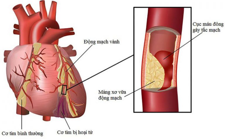 Sơ vữa động mạch vành