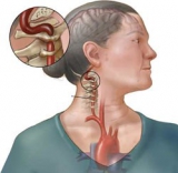 Dấu hiệu tiền chứng đột quỵ não