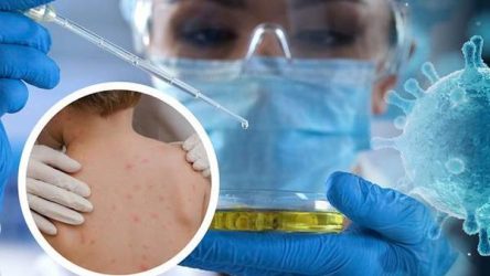 Bệnh đậu mùa khỉ: Đường lây truyền và cách phòng ngừa cần làm ngay