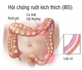 Hội chứng ruột kích thích – Dấu hiệu nhận biết và các phương pháp điều trị
